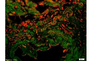Formalin-fixed and paraffin-embedded human colon carcinoma labeled with Anti-VE Cadherin/VECD/CD144 Polyclonal Antibody, Unconjugated (ABIN1387250) 1:200, overnight at 4°C, The secondary antibody was Goat Anti-Rabbit IgG, Cy3 conjugated used at 1:200 dilution for 40 minutes at 37°C.