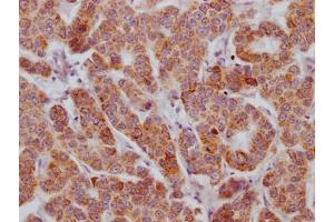 IHC image of ABIN7127321 diluted at 1:100 and staining in paraffin-embedded human breast cancer performed on a Leica BondTM system.