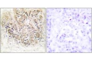 Immunohistochemistry analysis of paraffin-embedded human breast carcinoma tissue, using TCTP Antibody. (TPT1 anticorps  (AA 71-120))