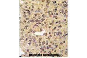 Formalin-fixed and paraffin-embedded human prostata carcinoma tissue reacted with MEN1 Antibody  (ABIN391613 and ABIN2841534) , which was peroxidase-conjugated to the secondary antibody, followed by DAB staining.