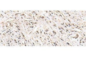 Immunohistochemistry of paraffin-embedded Human prost ate cancer tissue using ZNF281 Polyclonal Antibody at dilution of 1:30(x200) (ZNF281 anticorps)