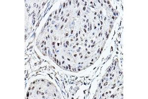 Immunohistochemistry of paraffin-embedded human esophageal cancer using MDC1 Rabbit pAb (ABIN6134688, ABIN6143659, ABIN6143661 and ABIN6216452) at dilution of 1:150 (40x lens).