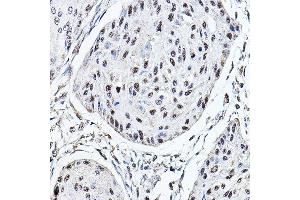Immunohistochemistry of paraffin-embedded human esophageal cancer using MDC1 Rabbit pAb (ABIN6134688, ABIN6143659, ABIN6143661 and ABIN6216452) at dilution of 1:150 (40x lens). (MDC1 anticorps  (AA 1-100))