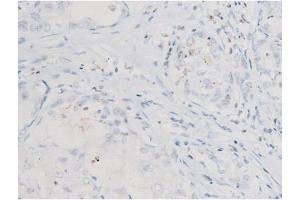 ABIN6267524 at 1/200 staining Human liver cancer tissue sections by IHC-P.