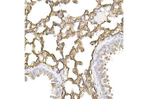 Immunohistochemistry of paraffin-embedded human lung cancer using ICAM-1/CD54 Rabbit pAb (ABIN6129231, ABIN6142118, ABIN6142120 and ABIN6221235) at dilution of 1:100 (40x lens).