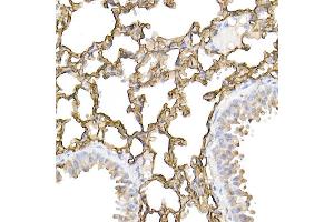 Immunohistochemistry of paraffin-embedded human lung cancer using ICAM-1/CD54 Rabbit pAb (ABIN6129231, ABIN6142118, ABIN6142120 and ABIN6221235) at dilution of 1:100 (40x lens). (ICAM1 anticorps  (AA 250-480))