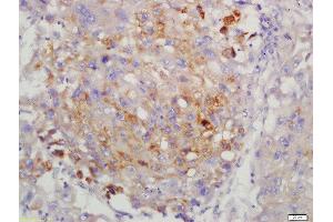 Formalin-fixed and paraffin embedded human lung carcinoma labeled with Anti-LMP7 Polyclonal Antibody, Unconjugated  at 1:200 followed by conjugation to the secondary antibody and DAB staining. (PSMB8 anticorps  (AA 171-272))