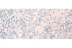 Immunohistochemistry of paraffin-embedded Human cervical cancer tissue using LILRA2 Polyclonal Antibody at dilution of 1:40(x200) (LILRA2 anticorps)
