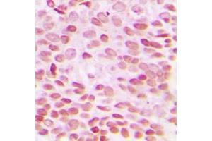Immunohistochemical analysis of GADD153 staining in human breast cancer formalin fixed paraffin embedded tissue section.