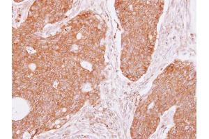 IHC-P Image DIAPH1 antibody [C2C3], C-term detects DIAPH1 protein at cytoplasm on human colon carcinoma by immunohistochemical analysis.