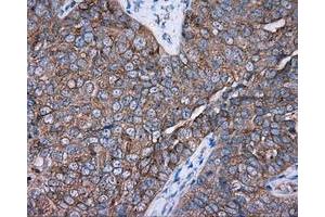 Immunohistochemical staining of paraffin-embedded Adenocarcinoma of colon tissue using anti-PRKAR2A mouse monoclonal antibody.