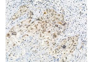Phospho-Histone H3 (Thr3) Antibody at 1/100 staining Human ovarian cancer by IHC-P. (Histone 3 anticorps  (H3T3ph))