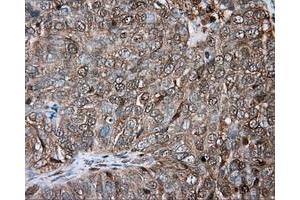 Immunohistochemical staining of paraffin-embedded Adenocarcinoma of ovary tissue using anti-PRKAR2A mouse monoclonal antibody. (PRKAR2A anticorps)