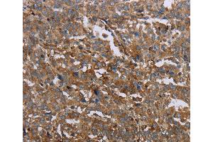 Immunohistochemistry of Human liver cancer using GCK Polyclonal Antibody at dilution of 1:40 (GCK anticorps)