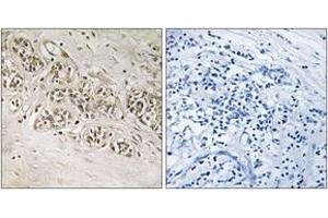 Immunohistochemistry analysis of paraffin-embedded human breast carcinoma, using RAD54B Antibody. (RAD54B anticorps  (AA 241-290))
