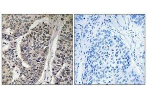 Immunohistochemical analysis of paraffin-embedded human breast carcinoma tissue, using p130 Cas (Phospho-Tyr410) antibody (left)or the same antibody preincubated with blocking peptide (right).