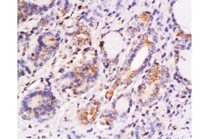 Formalin-fixed and paraffin embedded human thyroid carcinoma labeled with Anti-SKP2/skp2 p45 Polyclonal Antibody, Unconjugated  at 1:200 followed by conjugation to the secondary antibody and DAB staining.