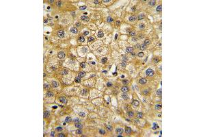 Formalin-fixed and paraffin-embedded human hepatocarcinoma with ADIPOR1 Antibody , which was peroxidase-conjugated to the secondary antibody, followed by DAB staining. (Adiponectin Receptor 1 anticorps  (C-Term))