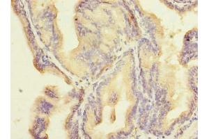 Immunohistochemistry of paraffin-embedded human prostate cancer using ABIN7176433 at dilution of 1:100