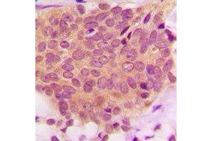 Immunohistochemical analysis of Ezrin/Radixin/Moesin  staining in human breast cancer formalin fixed paraffin embedded tissue section. (Ezrin anticorps  (C-Term))