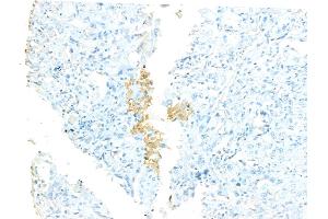 ABIN7094529 and ABIN7098578 at 1/100 staining Human lung cancer by IHC-P.