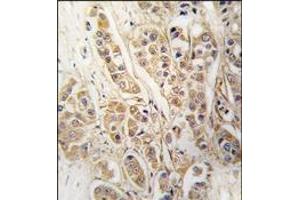Formalin-fixed and paraffin-embedded human breast carcinoma tissue reacted with CLIC4 antibody, which was peroxidase-conjugated to the secondary antibody, followed by DAB staining.