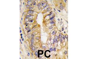 Formalin-fixed and paraffin-embedded human prostate carcinoma tissue reacted with PDGFRA polyclonal antibody  , which was peroxidase-conjugated to the secondary antibody, followed by DAB staining. (PDGFRA anticorps  (Tyr768))