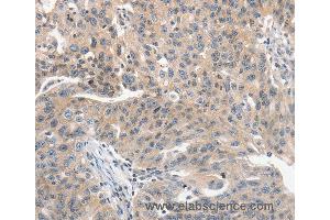 Immunohistochemistry of Human ovarian cancer using PRKD1 Polyclonal Antibody at dilution of 1:70 (PKC mu anticorps)