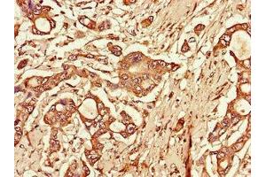 Immunohistochemistry of paraffin-embedded human pancreatic cancer using ABIN7172270 at dilution of 1:100 (TLR3 anticorps  (AA 135-297))