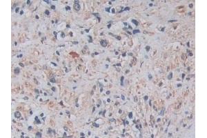 Detection of ADAM17 in Human Prostate cancer Tissue using Monoclonal Antibody to A Disintegrin And Metalloprotease 17 (ADAM17) (ADAM17 anticorps  (AA 226-473))