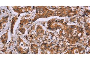 Immunohistochemistry of paraffin-embedded Human breast cancer tissue using CALCA Polyclonal Antibody at dilution 1:40 (CGRP anticorps)
