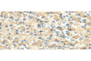 Immunohistochemistry of paraffin-embedded Human liver cancer using INHBB Polyclonal Antibody at dilution of 1/40