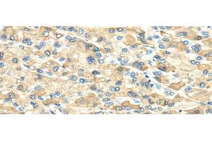 Immunohistochemistry of paraffin-embedded Human liver cancer using INHBB Polyclonal Antibody at dilution of 1/40 (INHBB anticorps)