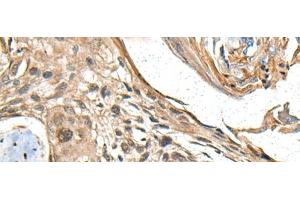 Immunohistochemistry of paraffin-embedded Human esophagus cancer tissue using MAPK4 Polyclonal Antibody at dilution of 1:35(x200) (MAPK4 anticorps)