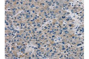 The image on the left is immunohistochemistry of paraffin-embedded Human liver cancer tissue using ABIN7131311(TBX18 Antibody) at dilution 1/20, on the right is treated with fusion protein. (T-Box 18 anticorps)