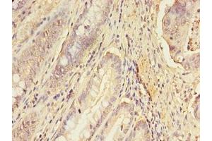 Immunohistochemistry of paraffin-embedded human colon cancer using ABIN7151689 at dilution of 1:100 (ERGIC1 anticorps  (AA 48-254))