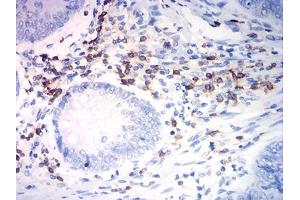 Immunohistochemical analysis of paraffin-embedded rectum cancer tissues using CD7 mouse mAb with DAB staining. (CD7 anticorps  (AA 26-180))