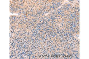Immunohistochemistry of Human thyroid cancer using CD109 Polyclonal Antibody at dilution of 1:30 (CD109 anticorps)