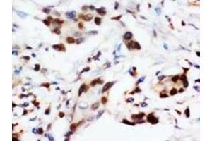 Immunohistochemical analysis of paraffin embedded cancer sections, staining in nucleus, DAB chromogenic reaction (BNIP3 anticorps  (C-Term))