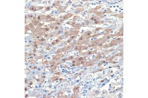Immunohistochemistry of paraffin-embedded human liver cancer using [KO Validated] Smad4 Rabbit mAb (ABIN7270340) at dilution of 1:100 (40x lens). (SMAD4 anticorps)