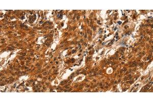 Immunohistochemistry of paraffin-embedded Human gastric cancer using CUEDC2 Polyclonal Antibody at dilution of 1:50