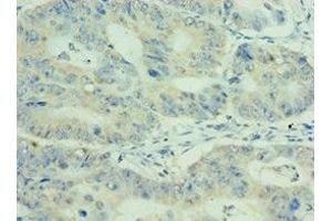 Immunohistochemistry of paraffin-embedded human colon cancer using ABIN7159411 at dilution of 1:100 (MEP1A anticorps  (AA 440-700))