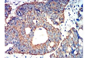 Immunohistochemical analysis of paraffin-embedded rectum cancer tissues using ATG3 mouse mAb with DAB staining. (ATG3 anticorps  (AA 1-100))