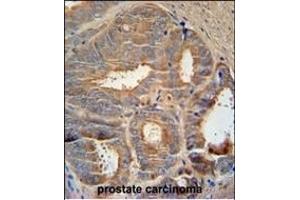 AZGP1 Antibody (N-term) (ABIN390565 and ABIN2840895) immunohistochemistry analysis in formalin fixed and paraffin embedded human prostate carcinoma followed by peroxidase conjugation of the secondary antibody and DAB staining.