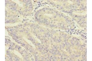 Immunohistochemistry of paraffin-embedded human endometrial cancer using ABIN7160214 at dilution of 1:100 (MORN5 anticorps  (AA 1-161))