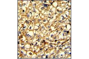 Formalin-fixed and paraffin-embedded human breast carcinoma with ADRA2B Antibody (Center), which was peroxidase-conjugated to the secondary antibody, followed by DAB staining.