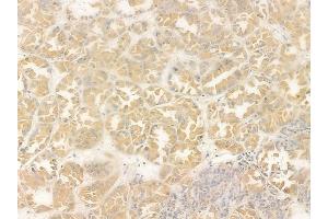 ABIN6263812 and ABIN6272374 at 1/100 staining human renal cell carcinoma by IHC-P.