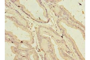 Immunohistochemistry of paraffin-embedded human prostate cancer using ABIN7144619 at dilution of 1:100 (ARMCX1 anticorps  (AA 29-300))