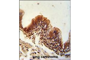TXNDC6 antibody immunohistochemistry analysis in formalin fixed and paraffin embedded human lung carcinoma followed by peroxidase conjugation of the secondary antibody and DAB staining.