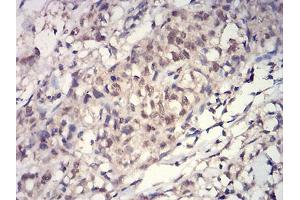Immunohistochemical analysis of paraffin-embedded breast cancer tissues using HIST2H3C(27Ac) mouse mAb with DAB staining. (Histone Cluster 2, H3c (HIST2H3C) (acLys27) anticorps)